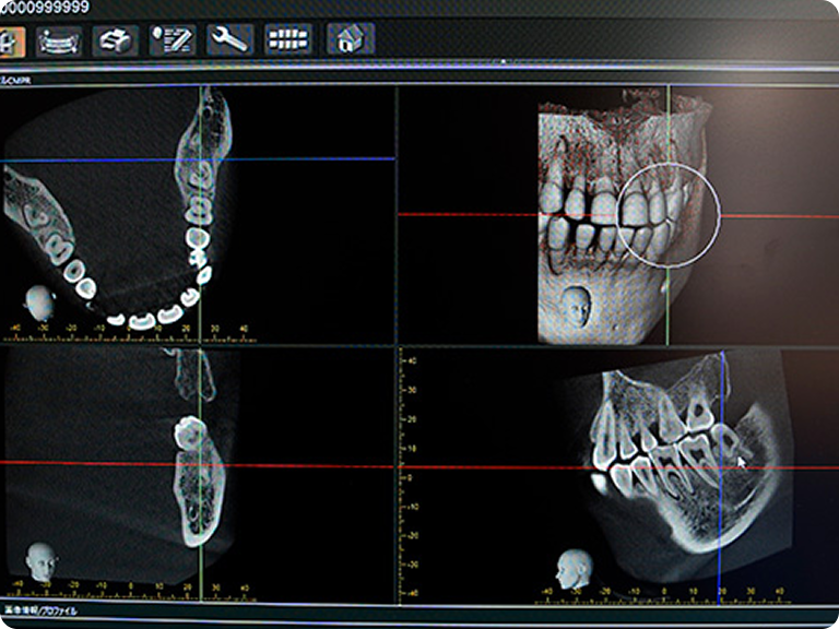 インプラントの構造